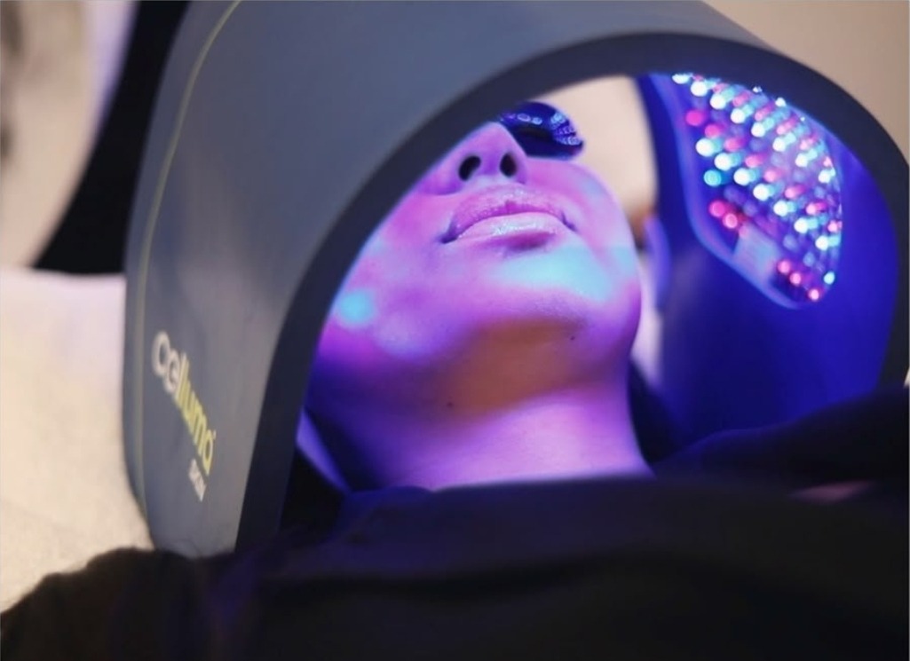 Chemical Peels